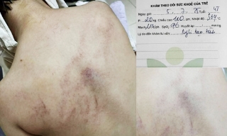 Vụ bé gái 4 tuổi bị đánh ở trường: Đình chỉ thêm giáo viên