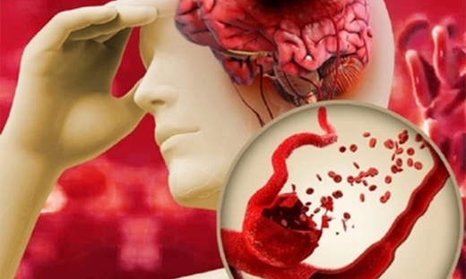 Bác sĩ chỉ bí quyết ngăn đột quỵ, nhồi máu cơ tim