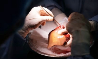Bỉ tìm ra hướng đi mới trong điều trị ung thư gan di căn